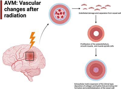 Microenvironment changes in arteriovenous malformations after stereotactic radiation